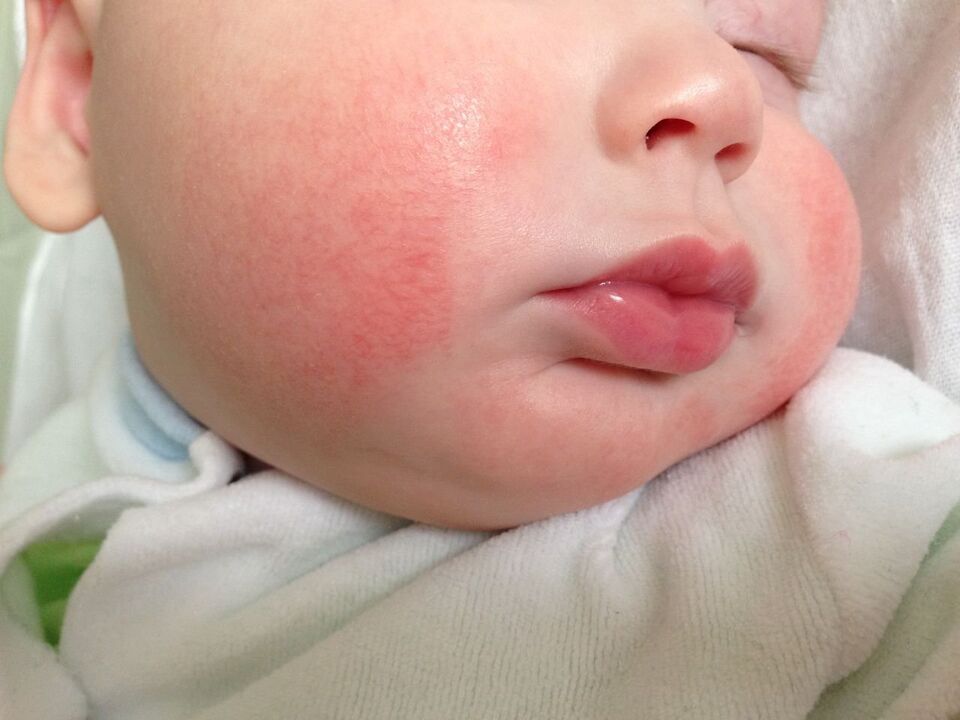 Знак на црви кај дете е алергиска уртикарија